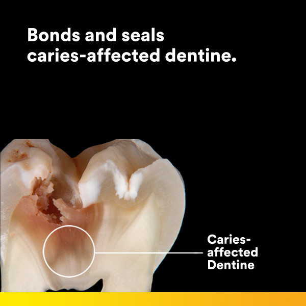 Caries-affected Dentine Bonding