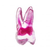 EndoTooth molar superior cu acces la 4 canale